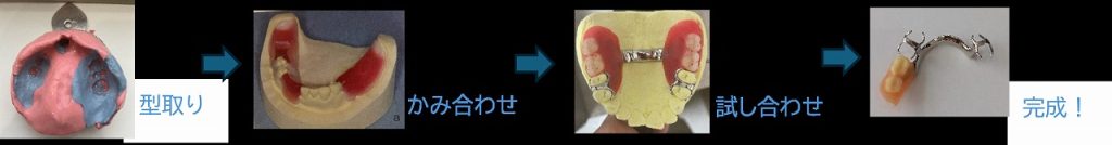 入れ歯が出来上がるまで