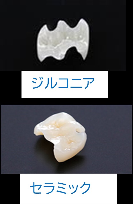 ジルコニアとセラミックって何が違ってどういいの？