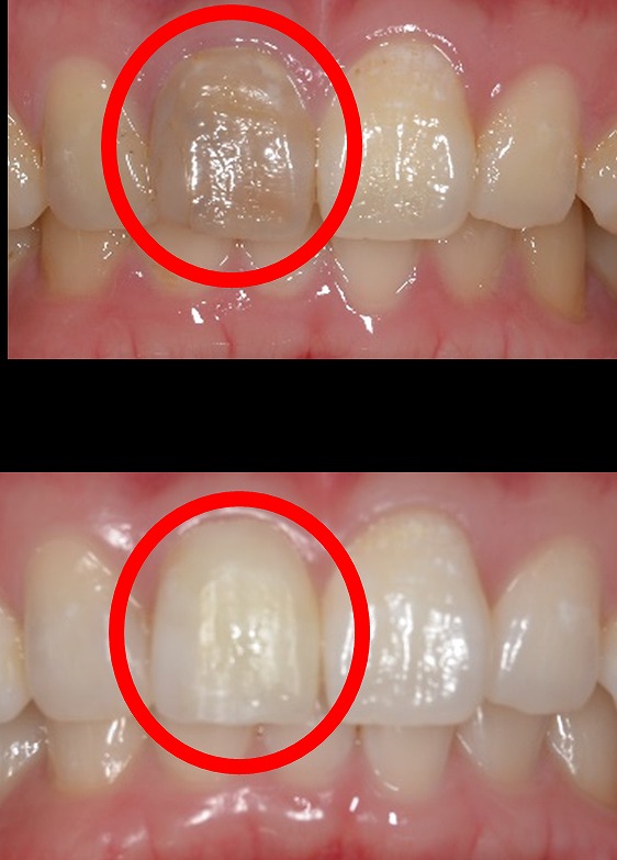 失活歯のホワイトニング（ウォーキングブリーチ）って何？🦷