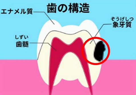 近年、根面う蝕が増加していることをご存知でしょうか？