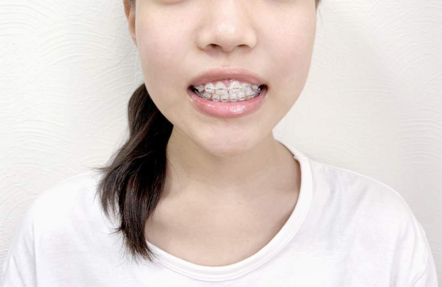 矯正治療とは〜美しい口元と正しい噛み合わせで健康を支える〜