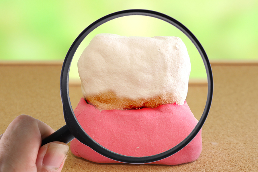 歯周病とは〜自覚症状なく静かに進行する、歯を失う大きな原因〜