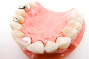 ４.歯周病治療