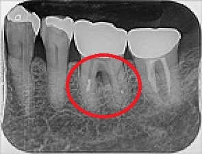 歯周再生治療 治療前