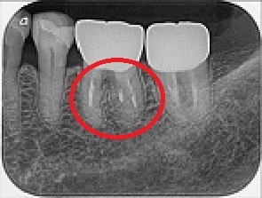 歯周再生治療 治療後