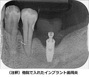 他院で入れたインプラント歯周炎