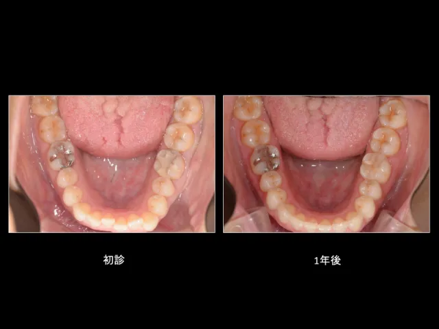 マウスピース型矯正歯科装置　～目立ちにくい矯正治療～