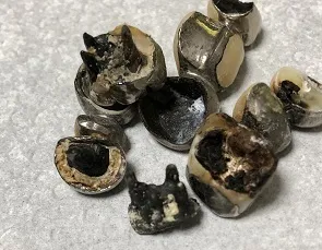 金属アレルギー
