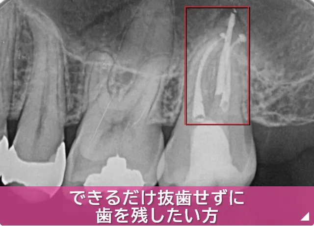 できるだけ抜歯せずに歯を残したい方