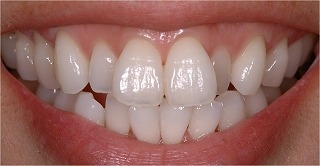 健康的な白い歯を再現したい方へ　～ホワイトニング～